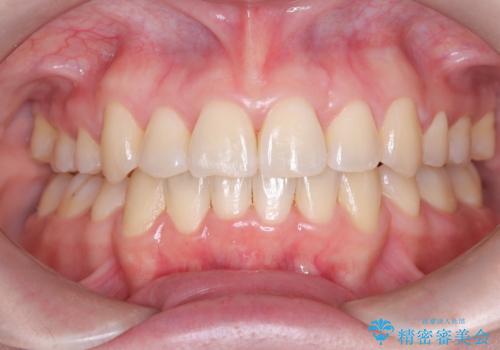 結婚式に向けた歯列矯正の症例 治療後