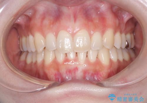インビザラインで整えた前歯の歯並びの治療後