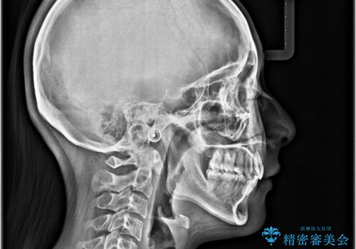 口元が出ているのを改善したい。 クリアブラケットによる抜歯矯正の治療後