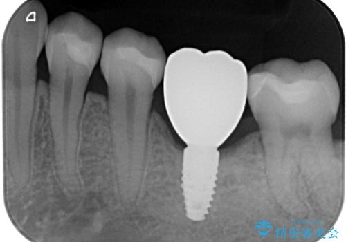 奥歯にインプラントを入れて銀歯もやり替えたい。の治療後