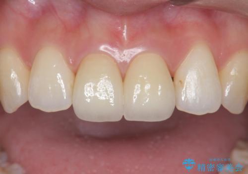 前歯を綺麗にしたい。の治療後