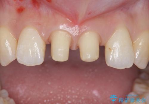 前歯を綺麗にしたい。の治療中