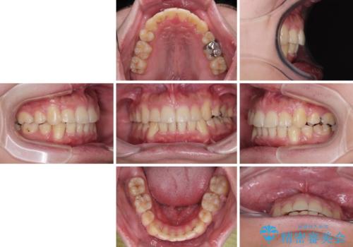 デコボコと口元の突出感を改善　抜歯矯正治療の治療後