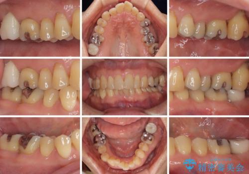 外側に飛び出している歯 部分矯正を用いた奥歯の補綴治療の治療後