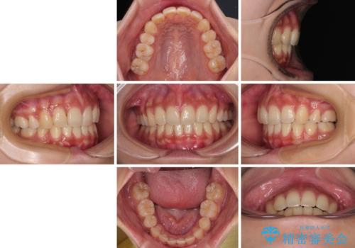 気になる上顎前突 補助装置を用いた抜歯矯正で口元をすっきりとの治療後