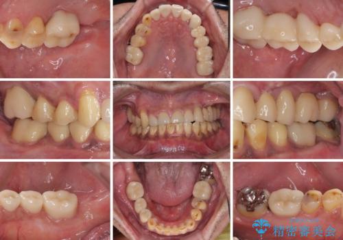 反対咬合ですり減った前歯とむし歯だらけの奥歯　総合歯科治療の治療後