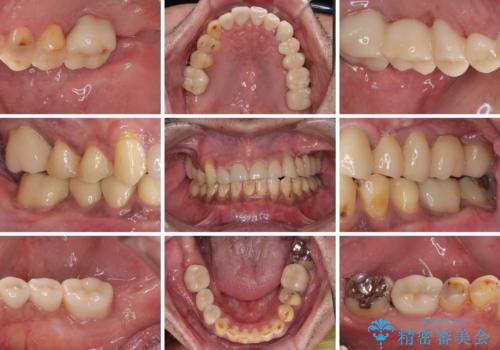反対咬合ですり減った前歯とむし歯だらけの奥歯 総合歯科治療の治療後