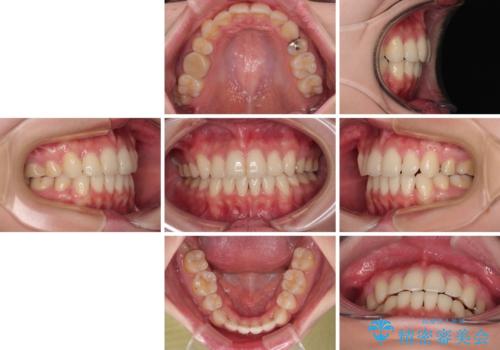 前歯のデコボコを抜歯矯正でスッキリした口元にの治療後