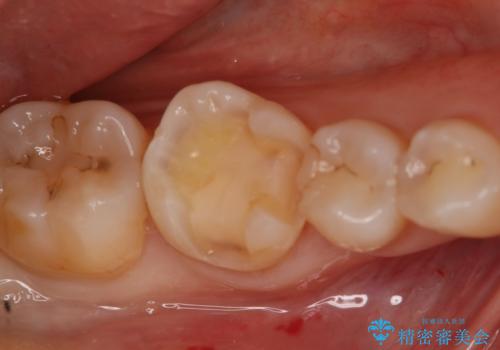銀の詰め物が取れた　セラミックインレー治療の治療中