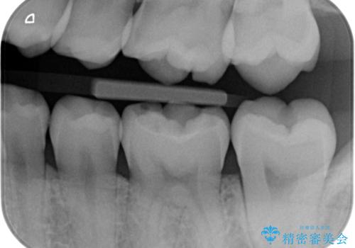 【歯に穴が空いている】ゴールドインレーで修復の治療前