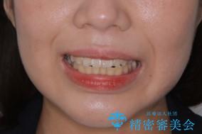 どこで噛んだらいいのかわからない:ワイヤーによる矯正治療の治療前(顔貌)