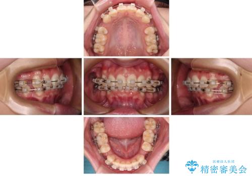口元が出ているのを改善したい。 クリアブラケットによる抜歯矯正の治療中