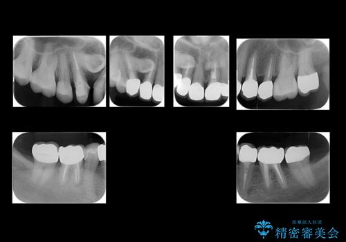 50代女性 銀歯をとって白いつめものに 全体的な治療の治療後