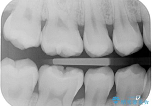 プラチナ金合金のインレー治療の治療前
