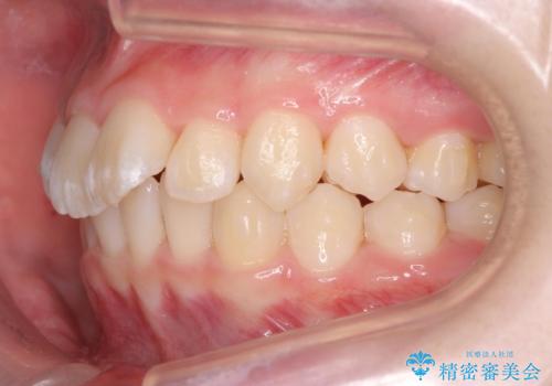 子供の出っ歯 生え代わりと成長期を利用して非抜歯で矯正の治療中