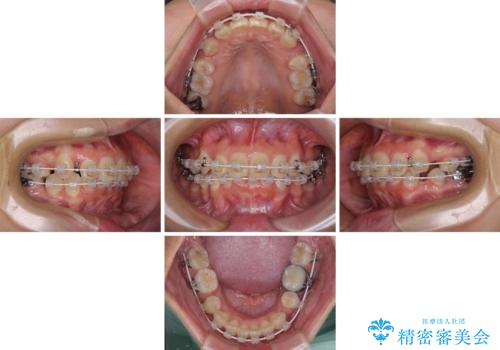 唇を閉じてもはみ出してしまう上顎前歯　抜歯矯正で口元を改善の治療中
