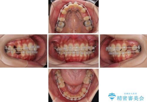 気になる上顎前突 補助装置を用いた抜歯矯正で口元をすっきりとの治療中