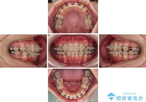 前歯のデコボコを抜歯矯正でスッキリした口元にの治療中