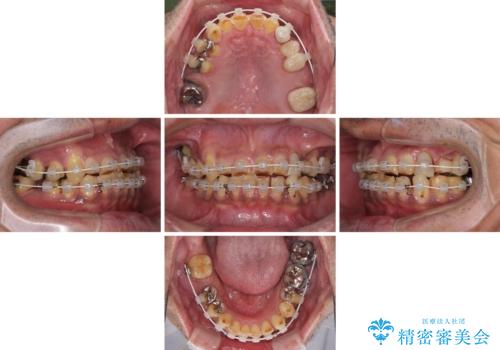 反対咬合ですり減った前歯とむし歯だらけの奥歯　総合歯科治療の治療中