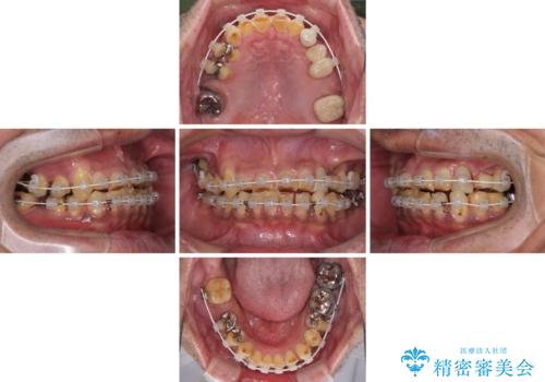 反対咬合ですり減った前歯とむし歯だらけの奥歯 総合歯科治療の治療中