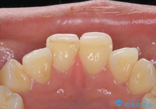 前歯を綺麗にしたい。の治療前