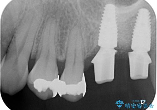 上顎奥歯のインプラント治療の治療中