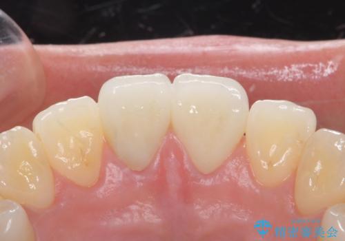 前歯を綺麗にしたい。の治療後