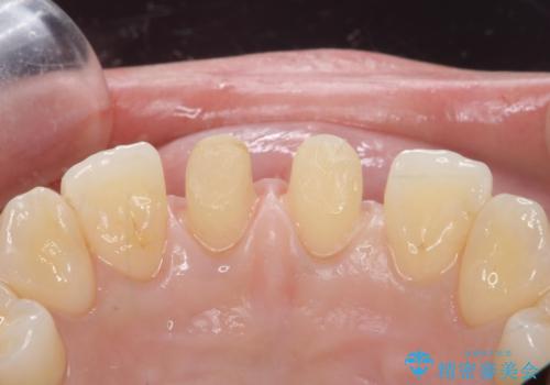 前歯を綺麗にしたい。の治療中