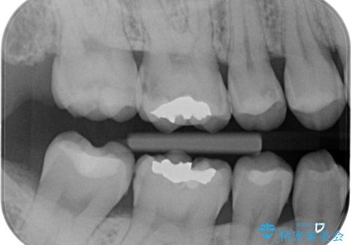 奥歯の虫歯の治療　の治療前