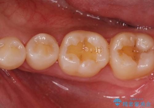 【歯に穴が空いている】ゴールドインレーで修復の症例 治療前