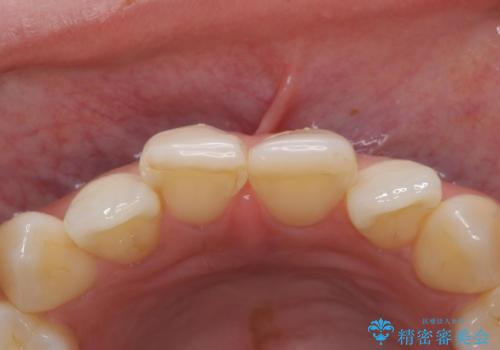 前歯を綺麗にしたい。の治療前