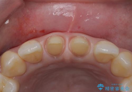 前歯を綺麗にしたい。の治療中