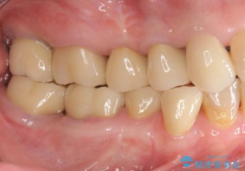 セラミック インプラント 全顎治療の治療後