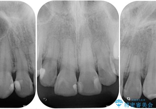 上の前歯の色味が気になる オールセラミッククラウン の治療前