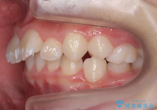 子供の出っ歯 生え代わりと成長期を利用して非抜歯で矯正の治療前