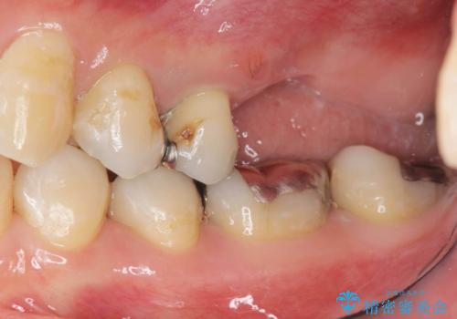 上顎奥歯のインプラント治療の治療前