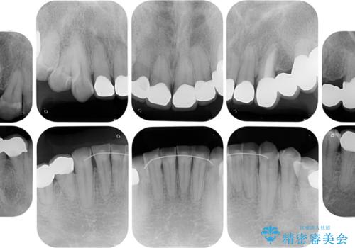 反対咬合ですり減った前歯とむし歯だらけの奥歯　総合歯科治療の治療後