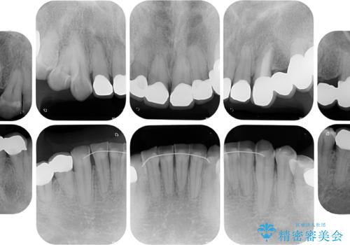 反対咬合ですり減った前歯とむし歯だらけの奥歯 総合歯科治療の治療後