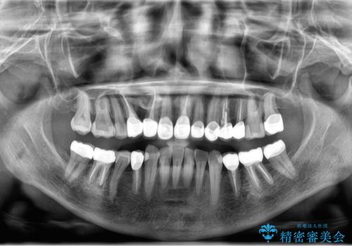 50代女性 銀歯をとって白いつめものに 全体的な治療の治療後