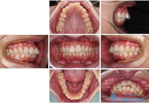 口元が出ているのを改善したい。 クリアブラケットによる抜歯矯正の治療前
