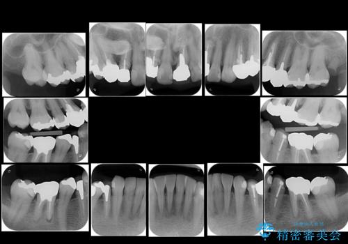 50代女性 銀歯をとって白いつめものに 全体的な治療の治療前