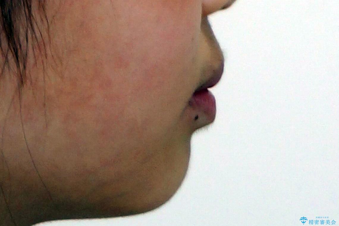 子供の出っ歯 生え代わりと成長期を利用して非抜歯で矯正の治療前(顔貌)