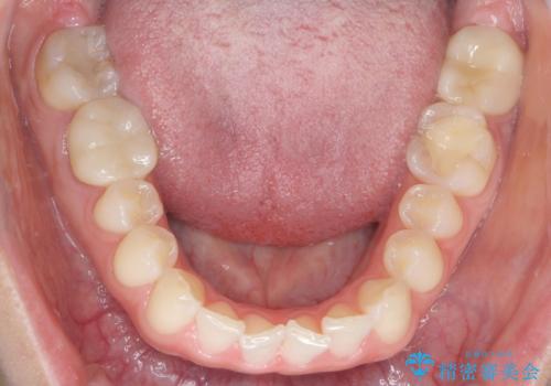 下の前歯のちょっとしたがたつきを治したい