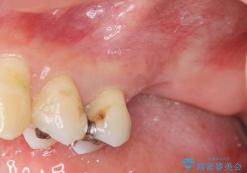 上顎奥歯のインプラント治療の治療前