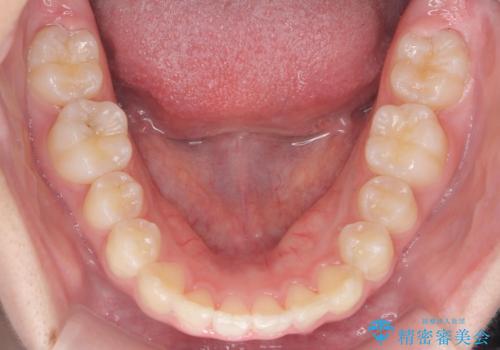 子供の出っ歯 生え代わりと成長期を利用して非抜歯で矯正の治療後