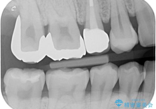 セラミックインレー。の治療前