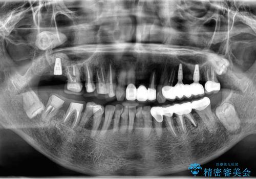 セラミック インプラント 全顎治療の治療中
