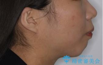 どこで噛んだらいいのかわからない:ワイヤーによる矯正治療の治療前(顔貌)