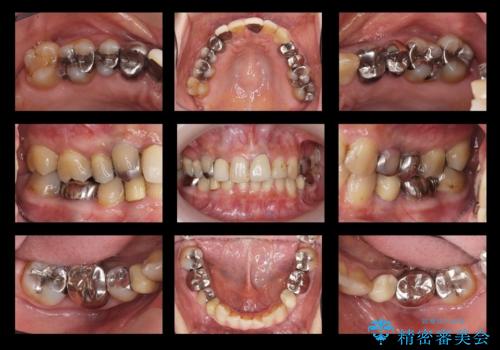 50代女性 銀歯をとって白いつめものに 全体的な治療の治療前