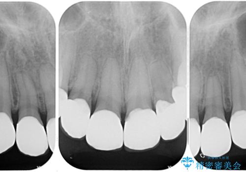 上の前歯の色味が気になる オールセラミッククラウン の治療後